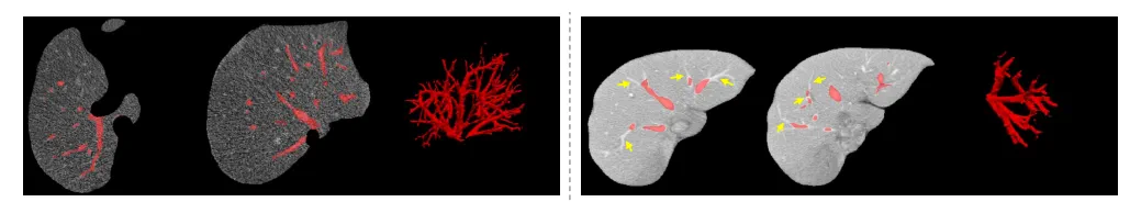 labeling liver vessel